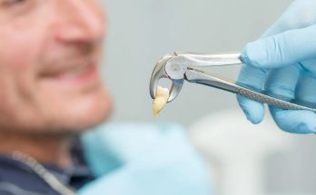 Fissure Sealant in Tehran A Simple Step to Prevent Tooth Decay