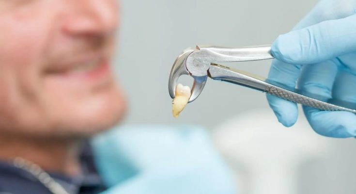 Fissure Sealant in Tehran A Simple Step to Prevent Tooth Decay